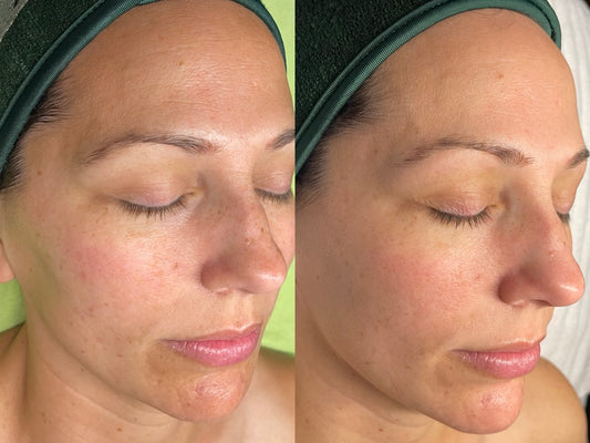 ProCell Micro Channeling