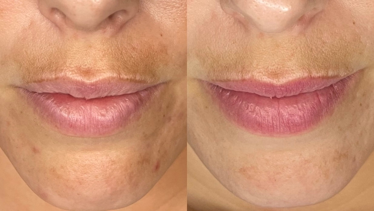 Chemical Peel